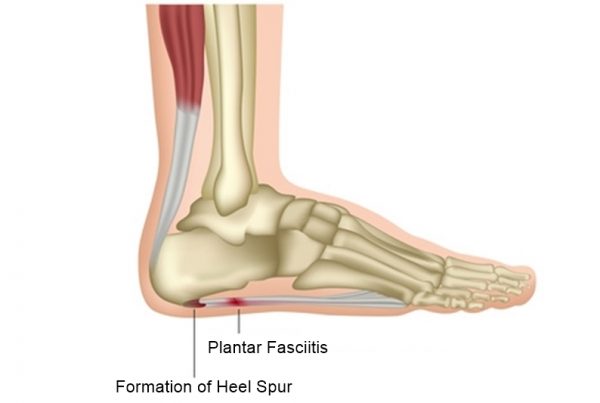 Plantar fasciitis, vector illustration german